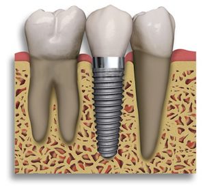 Dental Implants in Hunt Valley Maryland