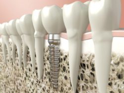 dental implant procedure in Cockeysville, MD