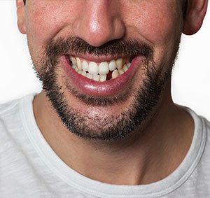 replacing missing teeth in Baltimore County, Maryland