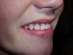 After Composite Veneers at Valley Dental Health