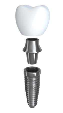 affordable dental implant services in Hunt Valley, MD by Valley Dental Health
