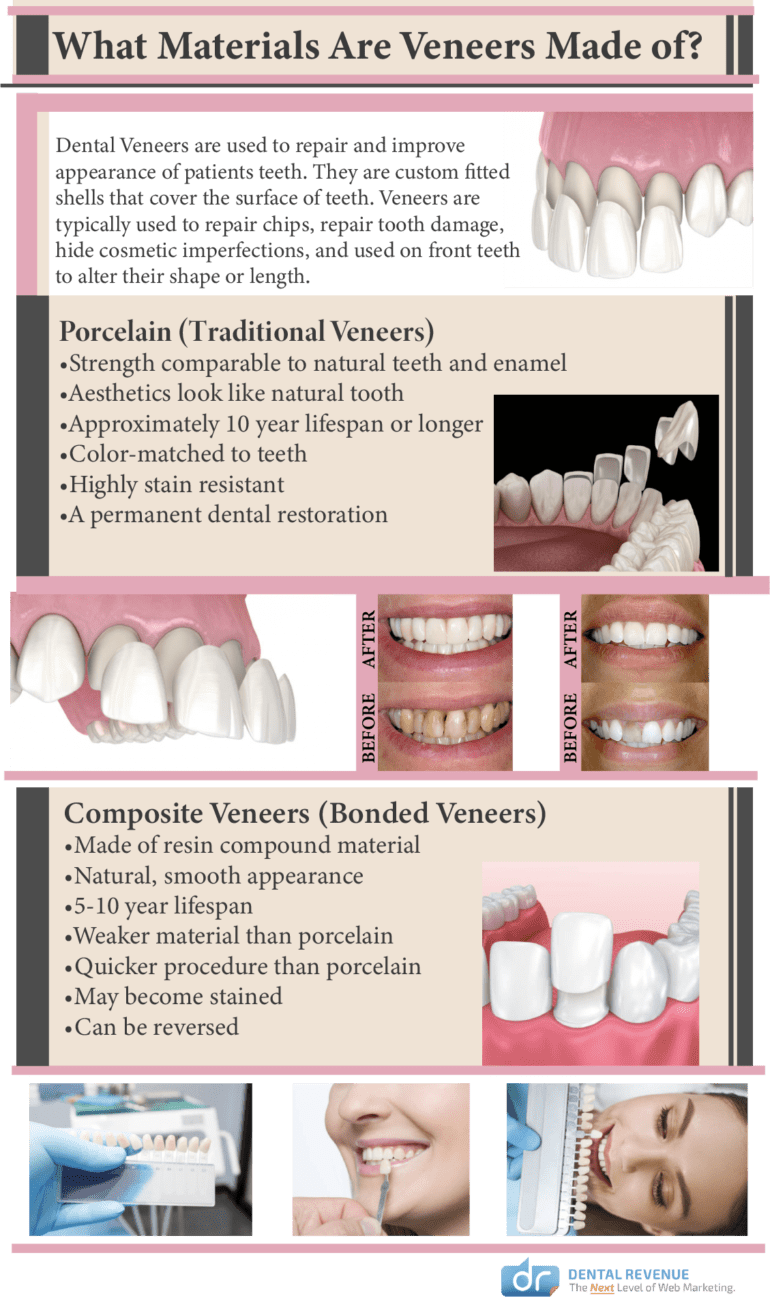 Types of Dental Veneers material Infographic