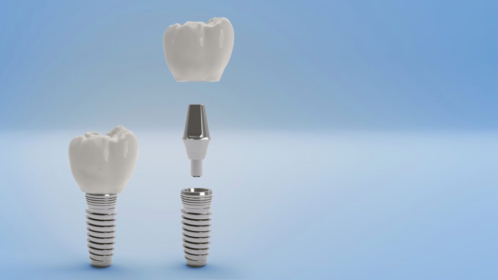 Facts You Didn't Know About Dental Implants