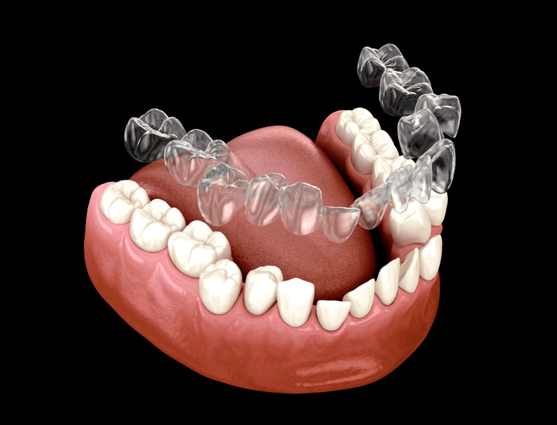 Invisalign special sale