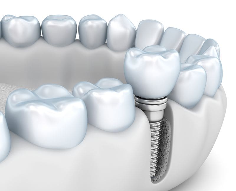 Cost of Dental Implants in Hunt Valley, MD