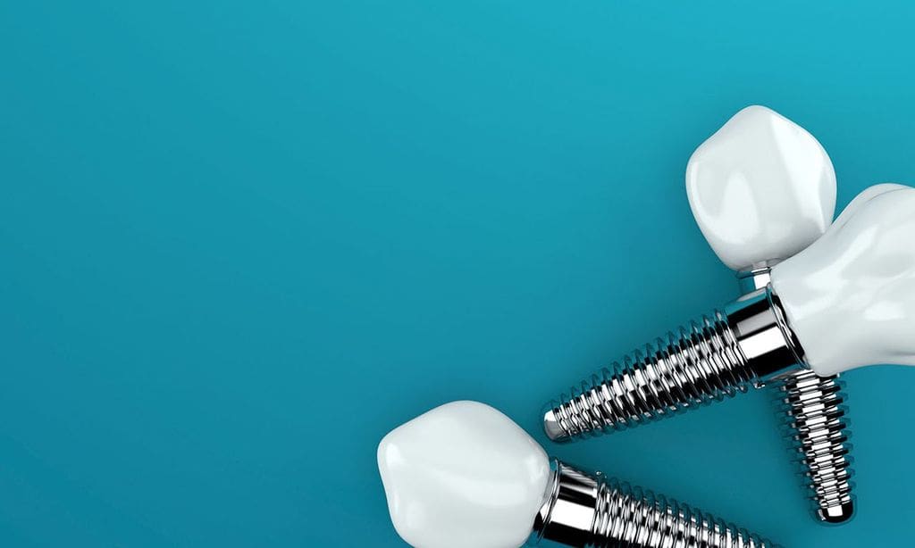 Dental Implants FAQ in Hunt Valley, MD