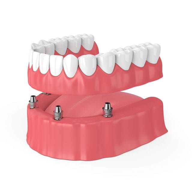 Dental Implants Procedure in Hunt Valley, MD