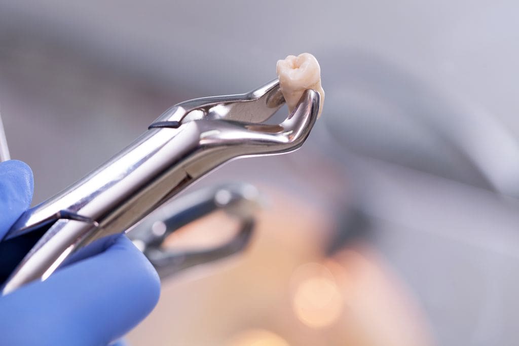 Tooth Extractions in Hunt Valley, MD