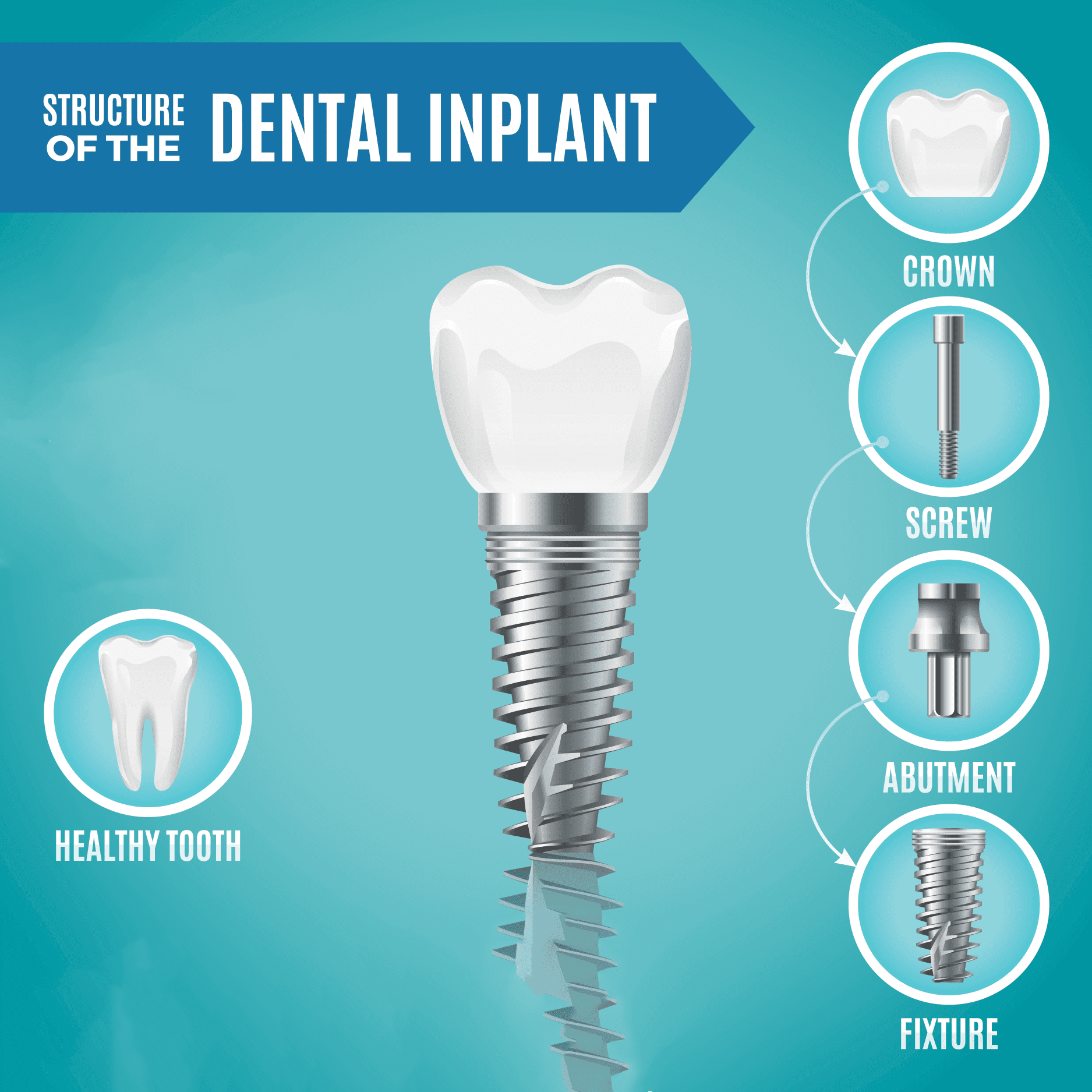 The process for dental implants can take several months