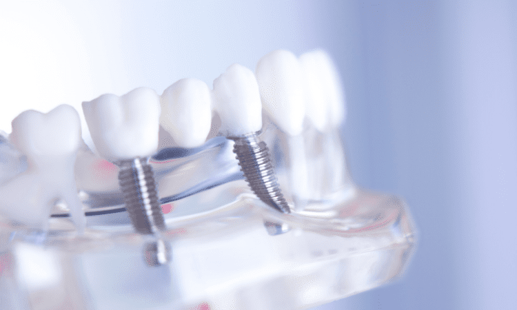 Understanding the different types of dental bridges available can help you make informed decisions about your dental care.