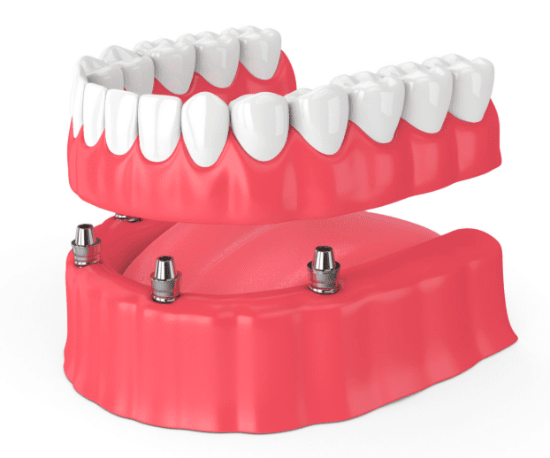 Dental implant-secured Denture