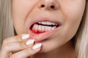 Treating bleeding gums and gum disease