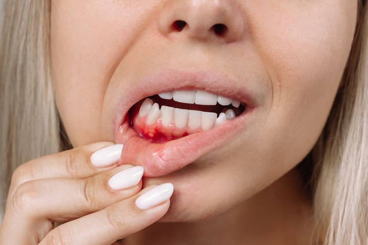 Treating bleeding gums and gum disease