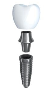 Anatomy of dental implant