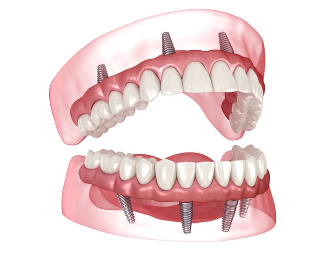 All-on-X implants in Cockeysville, MD