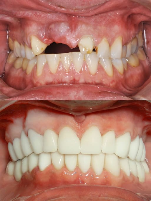 dental patient before and after a full-mouth reconstruction