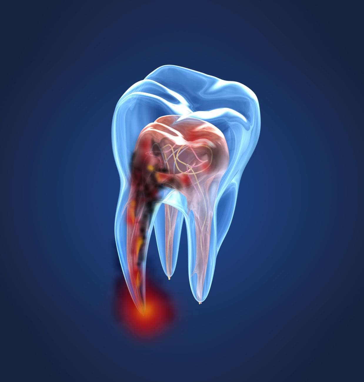 What Happens If You Skip the Crown After a Root Canal?