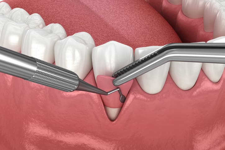 What Is Gum Grafting, Who Needs It, and Why a Periodontist Should Do It